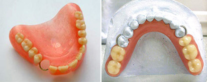 Зубные протезы из термопласта